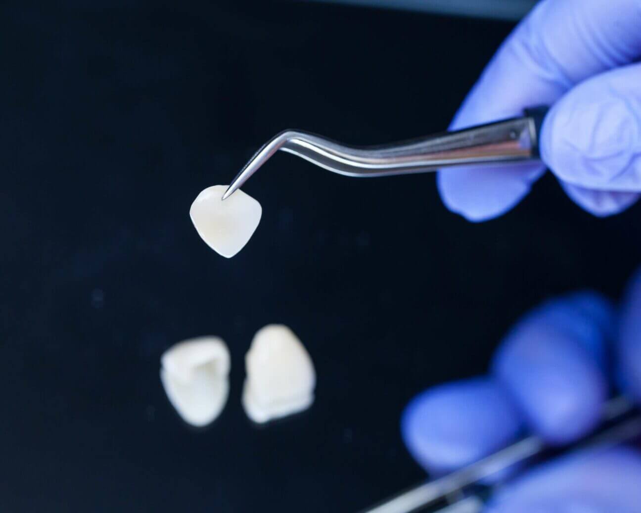 Veneers