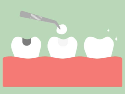 Amalgam